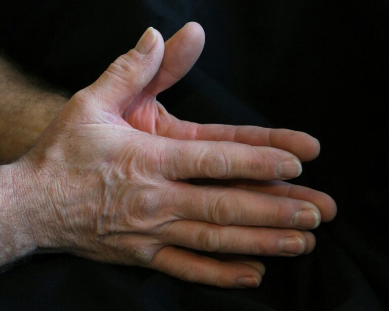 Parkinson, a Verona una nuova frontiera per la stimolazione cerebrale profonda